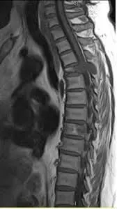 знімок хребта в області грудей