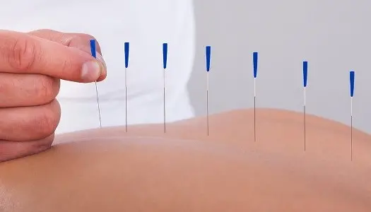 Лечение боли в спине иглоукалыванием Лечение боли в спине иглоукалыванием