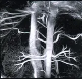 МРТ сосудов, отходящие от аорты. Сосуды почек МРТ сосудов, отходящие от аорты. Сосуды почек