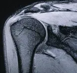 МРТ плечевого сустава МРТ плечевого сустава