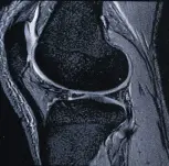 МРТ коленного сустава МРТ коленного сустава