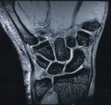 МРТ лучезапястного сустава МРТ лучезапястного сустава