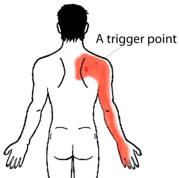 Боли по задней части спины и руке Боли по задней части спины и руке