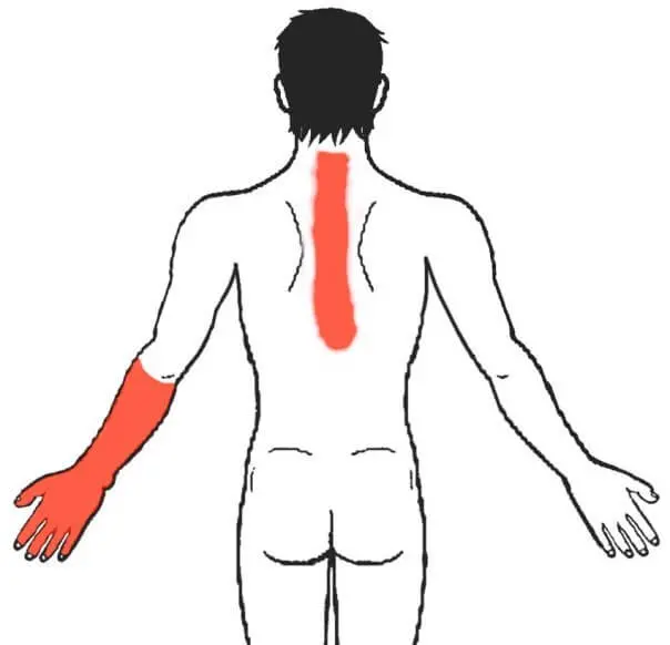 Th4 синдром (или «верхний грудной синдром») Th4 синдром (или «верхний грудной синдром»)