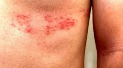 Опоясывающий лишай Опоясывающий лишай