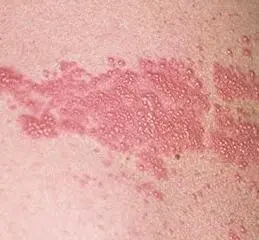 Высыпания имеют характерную картину Высыпания имеют характерную картину