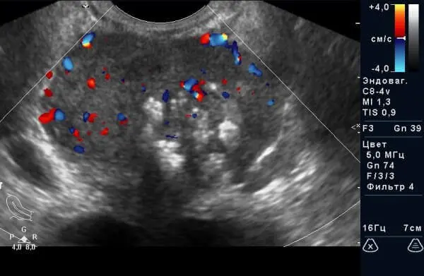УЗД органів малого тазу у чоловіків. Рак передміхурової залози УЗД органів малого тазу у чоловіків. Рак передміхурової залози