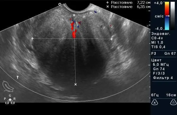 УЗД органів малого тазу у чоловіків. доброякісна гіперплазія УЗД органів малого тазу у чоловіків. доброякісна гіперплазія