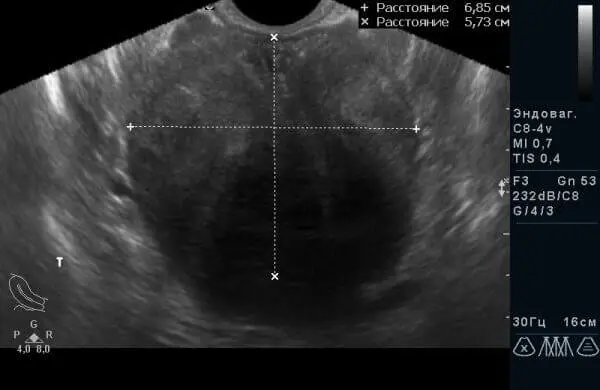 УЗД органів малого тазу у чоловіків. Той же пацієнт через 14 днів від початку консервативної терапії. УЗД органів малого тазу у чоловіків. Той же пацієнт через 14 днів від початку консервативної терапії.