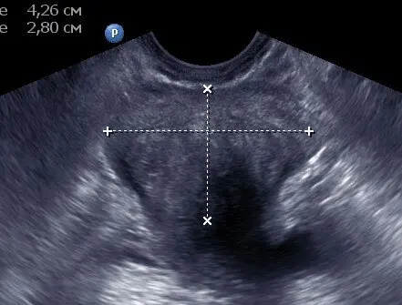 Мал. 5 Зникнення ділянок кальцинації після пройденого курсу лікування. Мал. 5 Зникнення ділянок кальцинації після пройденого курсу лікування.