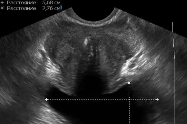 Мал. 4 Ділянки кальцинації центральної і парауретральной зон з щільною акустичної тінню. Мал. 4 Ділянки кальцинації центральної і парауретральной зон з щільною акустичної тінню.
