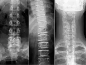 Рентген хребта