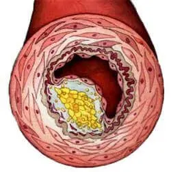 Смерть від атеросклерозу судин. Як цього уникнути?