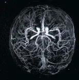 Смерть від атеросклерозу судин. Як цього уникнути?