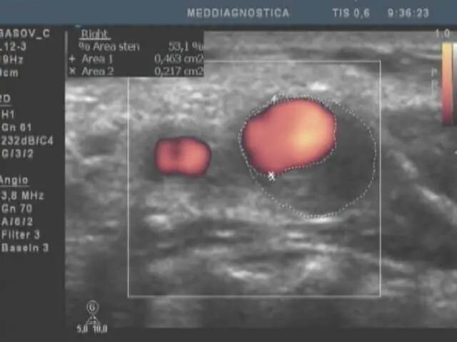 Смерть від атеросклерозу судин. Як цього уникнути?