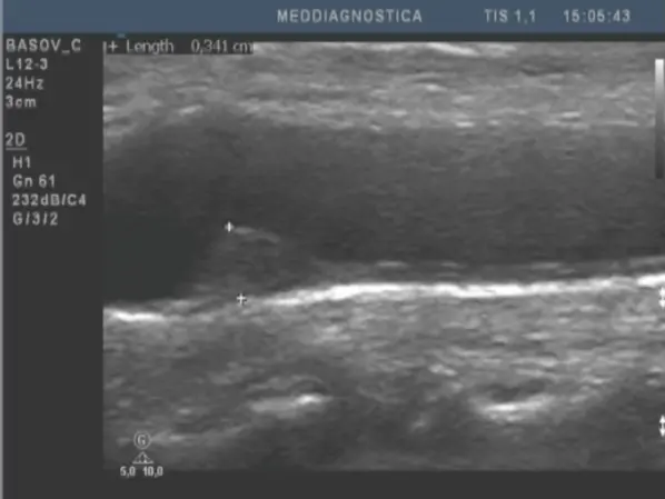 Смерть від атеросклерозу судин. Як цього уникнути?