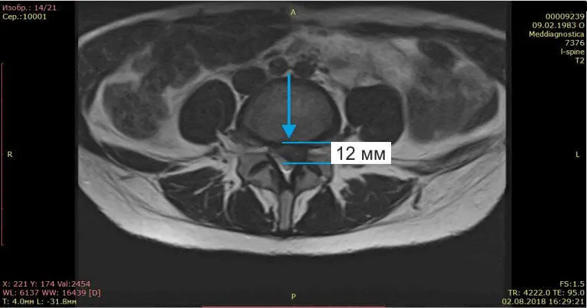 МРТ позвоночника до лечения грыжи диска