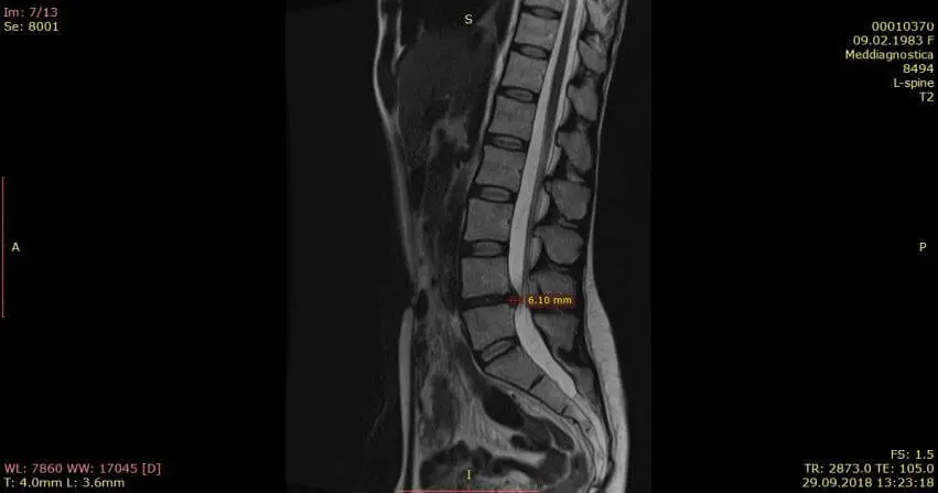 МРТ позвоночника, через 1 месяц грыжа уменьшилась на 50%