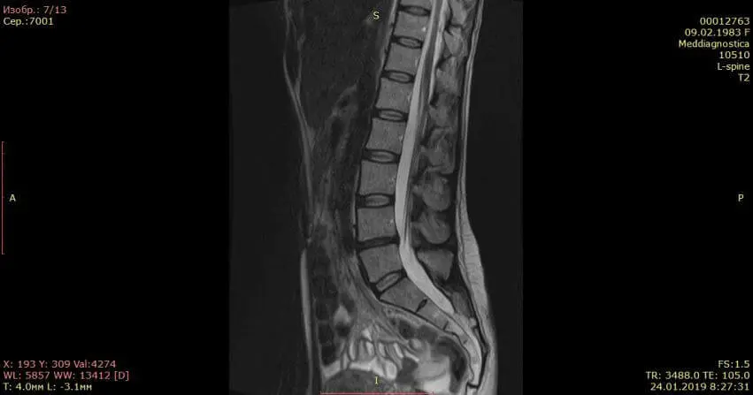 Контрольный МРТ, через 5 месяцев показал полное отсутствие грыжи диска