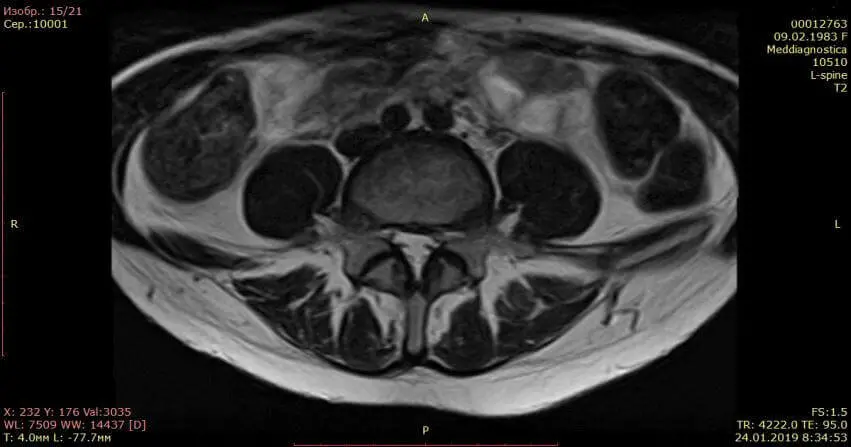 МРТ позвоночника после лечения грыжи диска