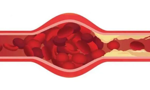закупоренный сосуд