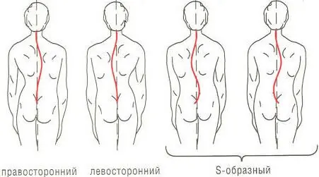 Неврологічна реабілітація