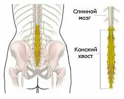 протрузия позвоночника