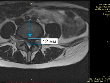 Лечение грыжи диска без операции Лечение грыжи диска без операции
