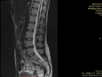 Лечение грыжи диска без операции Лечение грыжи диска без операции