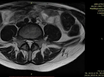 Лечение грыжи диска без операции Лечение грыжи диска без операции
