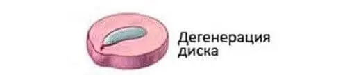 дегенерация межпозвоночного диска