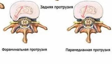 типы протрузий дисков