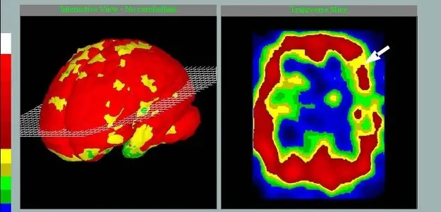 Старение начинается с сосудов мозга