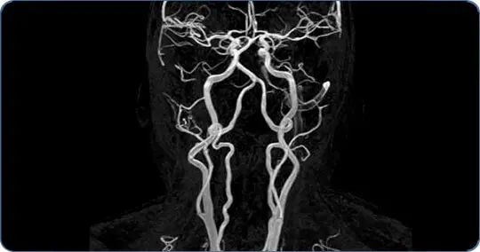 Старение начинается с сосудов мозга