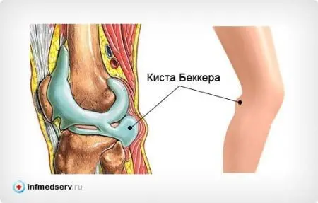 Как избежать операции на коленном суставе