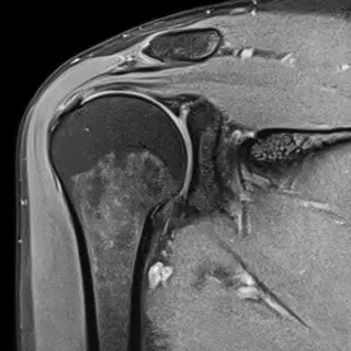 Как избежать операции на коленном суставе