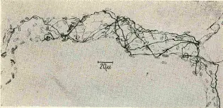 Вегетативно-сосудистая дистония и минимальная мозговая дисфункция