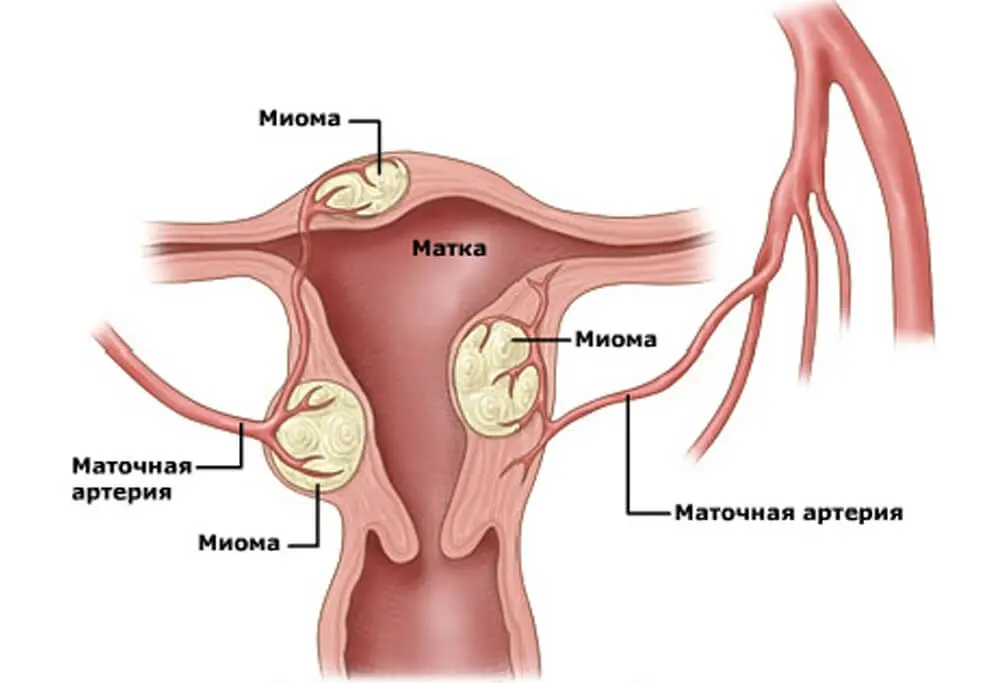 Миома матки лечение, симптомы, дигностика Миома матки лечение, симптомы, дигностика