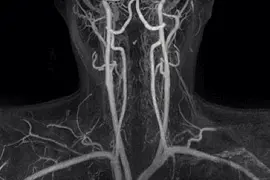 мрт дослідження судин шиї