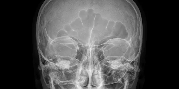 Рентген придаткових пазух