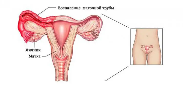 Лечение аднексита Лечение аднексита