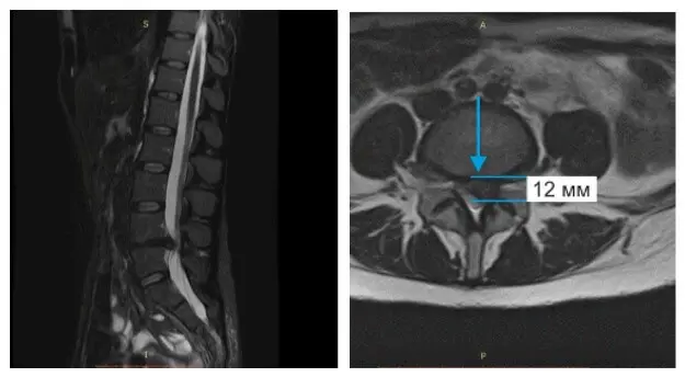 Большая грыжа 12 мм.