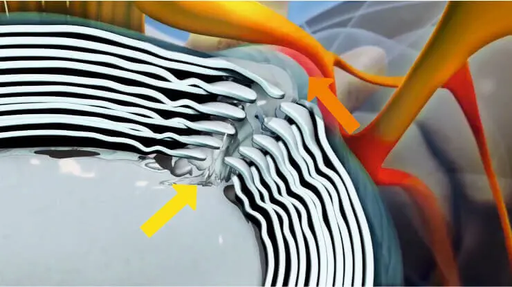 Выпячивание диска и давление на корешок Выпячивание диска и давление на корешок