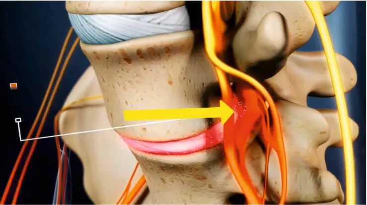 Грыжа давит на корешок Грыжа давит на корешок