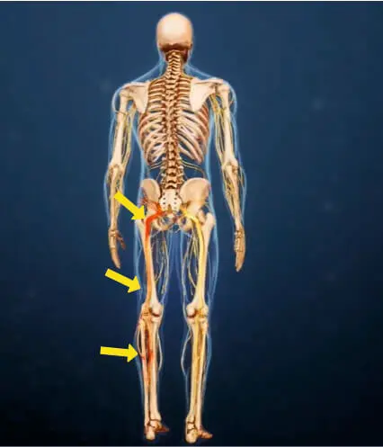 Почему грыжа диска вызывает боль в ноге и руке