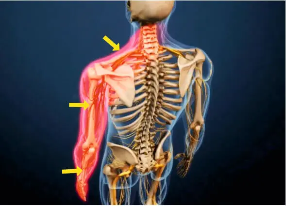 Боль в руке при грыже шейного отдела позвоночника Боль в руке при грыже шейного отдела позвоночника
