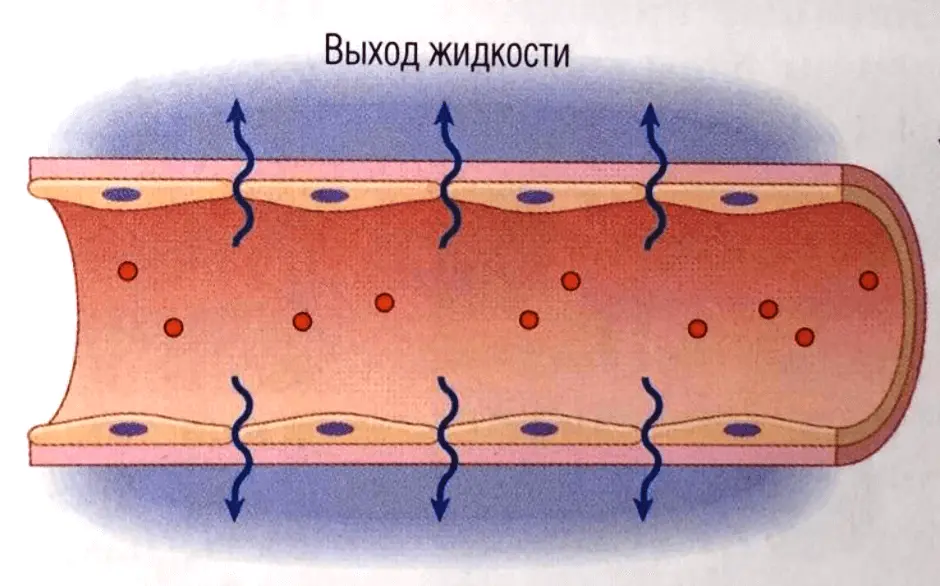 Сосуд растягивается, жидкость проникает в окружающие ткани Сосуд растягивается, жидкость проникает в окружающие ткани
