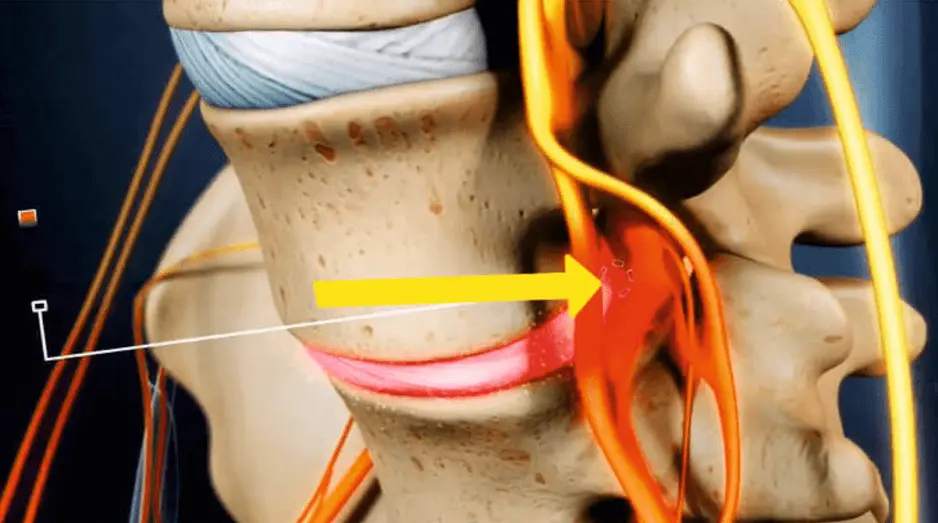 Радикулит: воспаление корешка при грыже диска