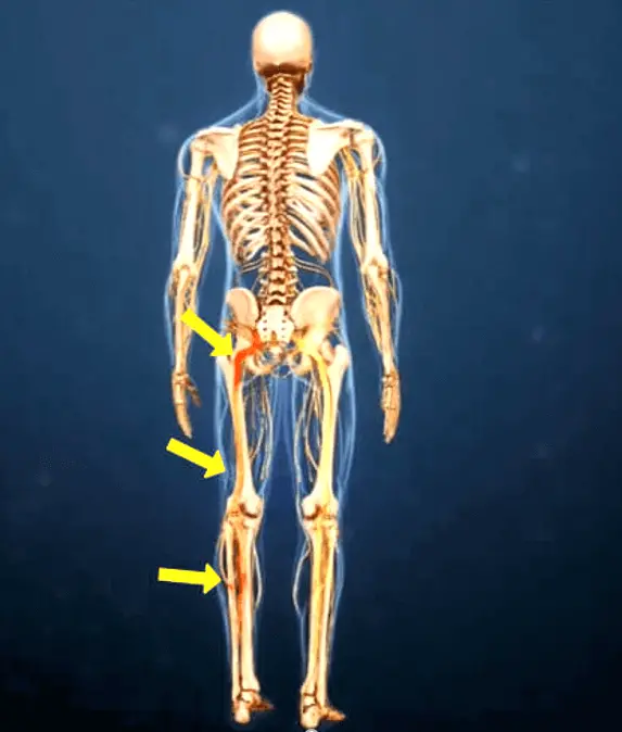 Боль в ноге: воспаление седалищного нерва Боль в ноге: воспаление седалищного нерва