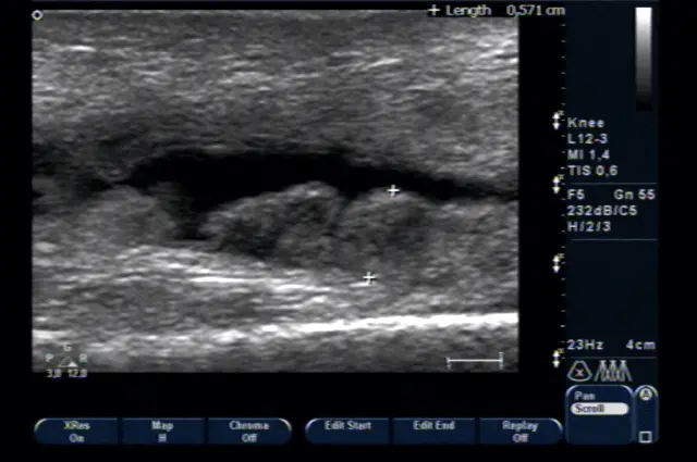 Ревматическое поражение суставов на УЗИ лікування ревматичних захворювань